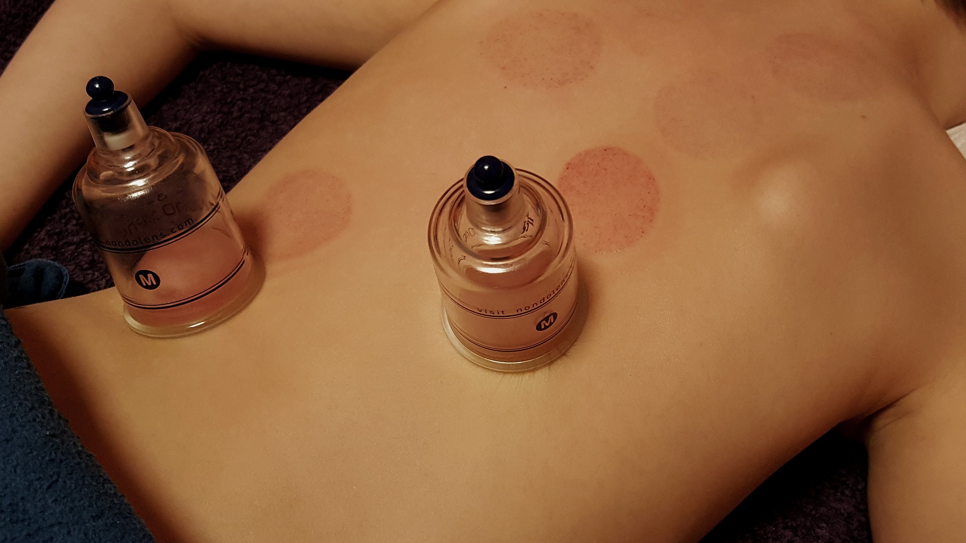 cupping-3310182_1920